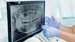 Types of cavities, pit and fissure cavities, smooth surface cavities and root cavities.