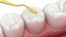 What to Know About Composite Fillings