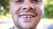 Chipped Tooth vs Cracked Tooth