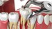 Tooth extractions, post extraction instructions and post extraction care