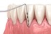 Why Does the Dentist Poke at My Gums During an Exam?