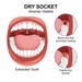 What is dry socket, what causes dry socket
