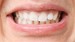 Periodontic Treatment - Diagnosis, Care, and Prevention