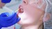 Are Fluoride Treatments Worth It for Adults?