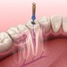 Do You Really Need a Root Canal?